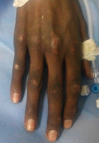Gottron's papules over dorsal aspect of the metatarsophalangeal and proximal inter-phalangeal joints.